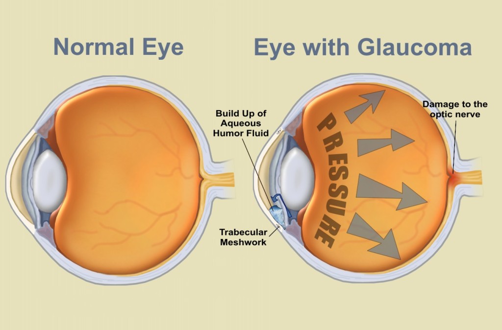 Normale Eye vs. Eye with Glaucoma