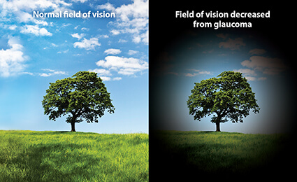 glaucom vizual